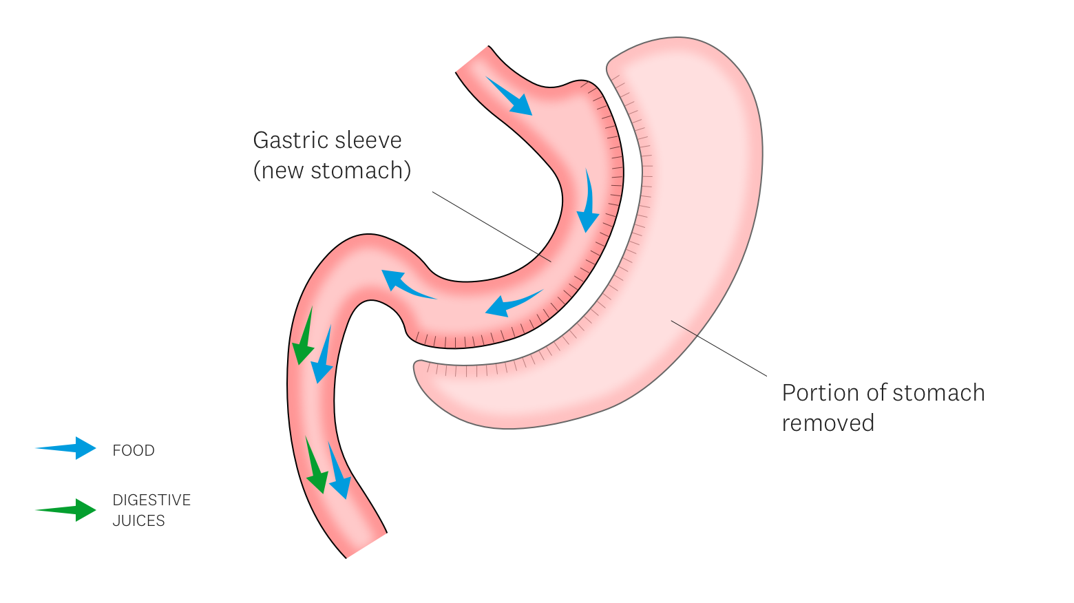 Gastric Sleeve