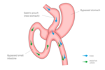 One Anastomosis Gastric Bypass 