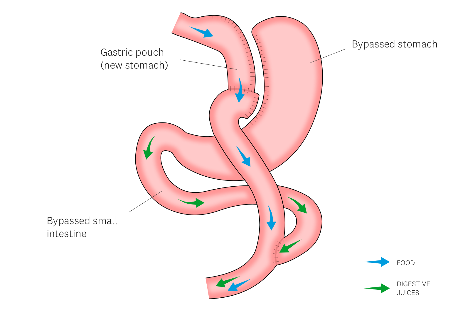 Roux en Y Gastric Bypass